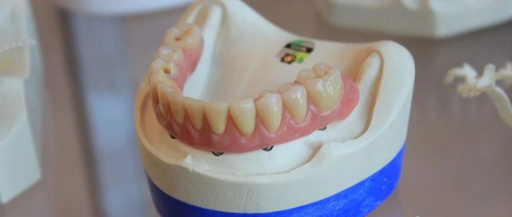 一颗牙成千上万！口腔专家告诉你「种牙」到底贵在哪里